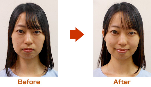 施術前・施術後
